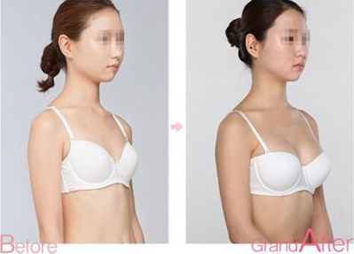 成都耳軟骨復(fù)合隆鼻手術(shù)：專家解析耳軟骨隆鼻效果及價(jià)格、術(shù)后護(hù)理