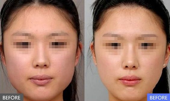 透明質(zhì)酸隆鼻：舒適隆鼻手術(shù)讓你更自信