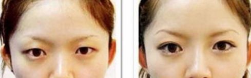 射頻技術(shù)能否有效消除眼袋并保持效果持久？