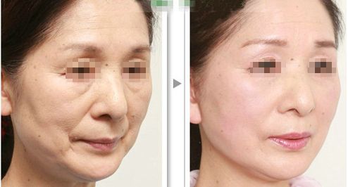 解脂能祛眼袋嗎？多少錢？功效與注意事項(xiàng)詳解