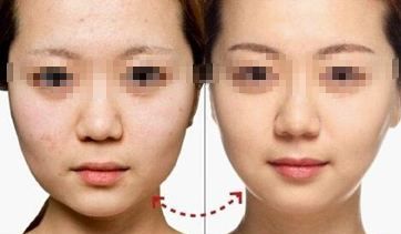 陰道緊縮術(shù)療程多久見效？