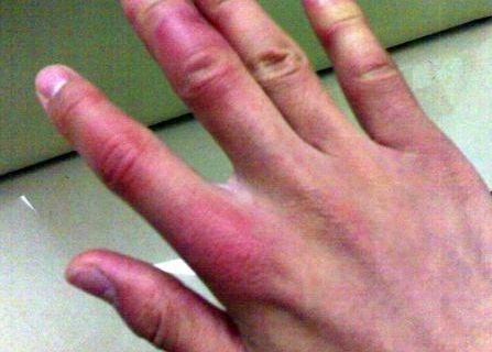 耳廓再造術前的準備攻略解析