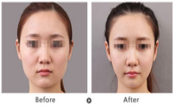 自體脂肪豐胸方案靠譜嗎？恢復(fù)時(shí)間需要多久？美胸關(guān)鍵要點(diǎn)一覽！