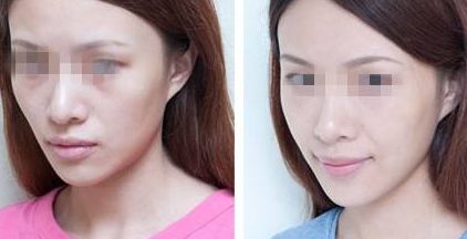 祛眼袋吸脂術(shù)后恢復(fù)需要多少時(shí)間