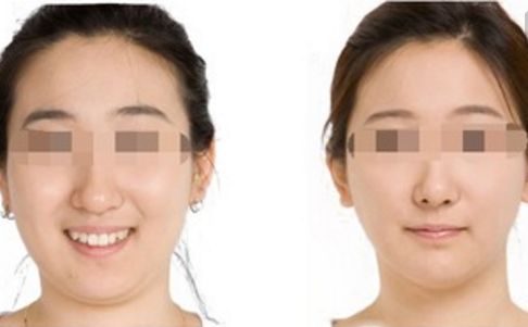 手術(shù)整形與微整形區(qū)別及比較：哪個更適合您的需求？