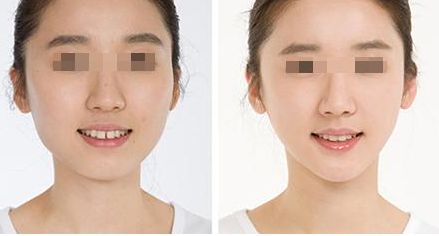 鼻整形手術(shù)價(jià)格分析：效果原理講解，術(shù)后注意事項(xiàng)，不良反應(yīng)剖析