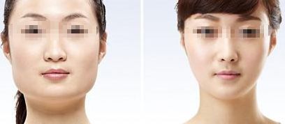 有效去除咬肌的兩種方法，輕松擁有優(yōu)美小臉