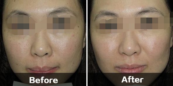 夏季控油護膚攻略，上海醫(yī)美整形控油方法一覽