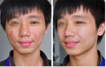 玻尿酸隆鼻，副作用與效果？解析真實(shí)趨勢(shì)！