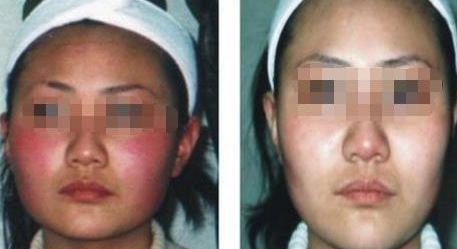 中醫(yī)祛斑的有效解決辦法，4個(gè)實(shí)用方案曝光！取得完美肌膚的干貨！