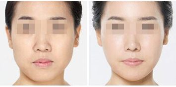 重慶隆胸費用參考及項目價格分享