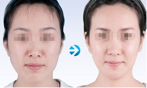 激光祛疤：了解效果如何，專業(yè)分享解析