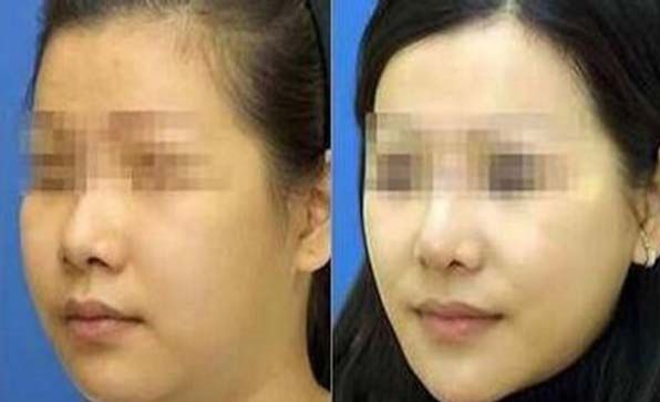 下頜角整形后水腫如何緩解