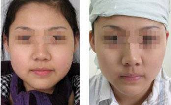 硅膠假體隆胸手術(shù)：效果如何？安全程度如何評(píng)價(jià)？