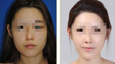 西寧華美整形腹部減脂，有效方法大揭秘！