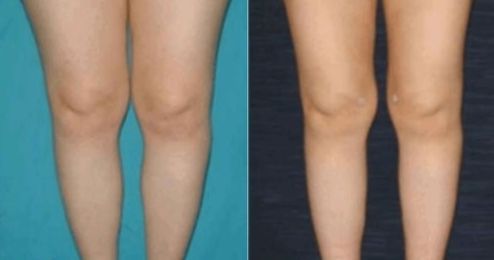 內(nèi)眼角開眼手術(shù)前需留意的要點(diǎn)