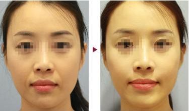 周口六院洗牙價(jià)格查詢