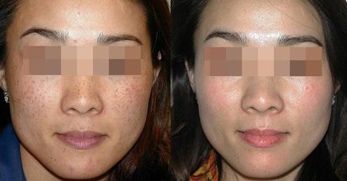 如何有效解決雙眼皮修復(fù)問題