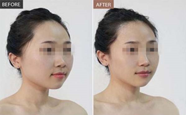 蘇州脈沖祛斑是怎么做的？這種激光祛斑的方法有哪些特點(diǎn)？