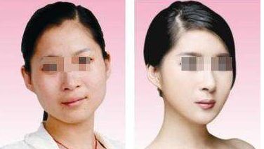 假體隆乳會對身體造成什么危害？隆乳須知一覽