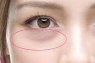 眼瞼外翻問(wèn)題的療效如何？