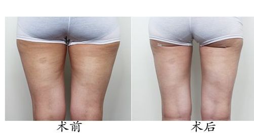 體驗(yàn)光子嫩膚，解密北京光子嫩膚價(jià)格