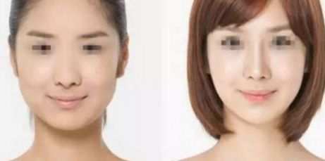 雙眼皮修復(fù)術(shù)最佳時(shí)機(jī)是什么時(shí)候？