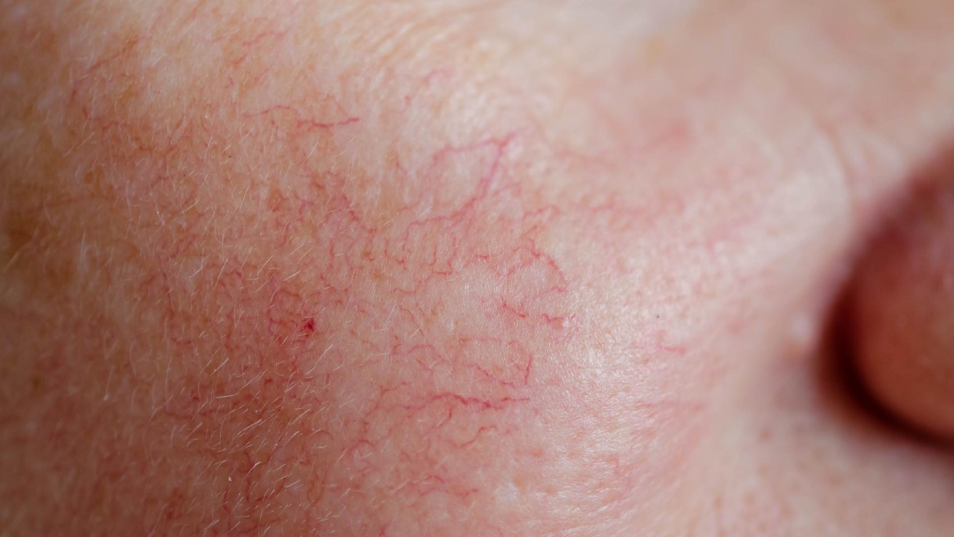 最佳祛痘法，有效消除面部痘印的方法大全