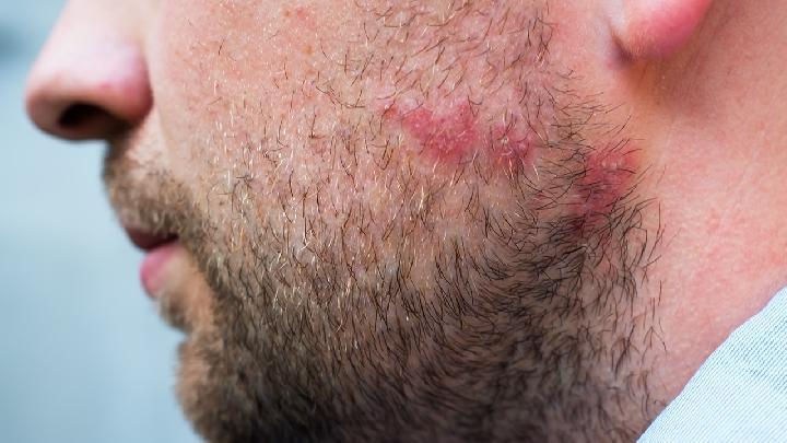 清除痘痘的5大技巧，快速排除面部瑕疵