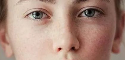 稱贊王博謙割雙眼皮的經歷了如何？分亞洲變化發(fā)生，介紹迥異案例