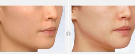 鄭州整形專家推薦：揭秘口碑醫(yī)院排行榜，讓您選擇脂肪填充?？漆t(yī)院更輕松