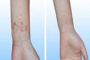 祛除眼袋的方法及注意事項(xiàng)有哪些？