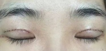 上海王會(huì)勇醫(yī)生鼻部整形案例分享：創(chuàng)新技術(shù)助您獲得完美鼻型！