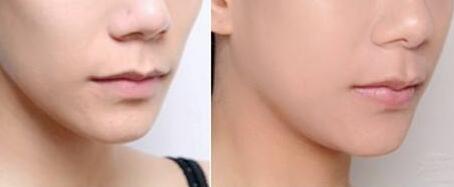 深圳徐斌的隆胸手術(shù)值得信任嗎？