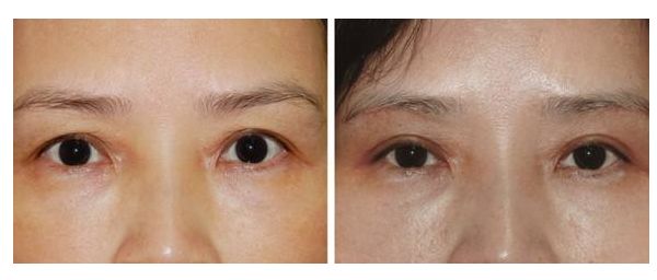 女生變成網(wǎng)紅臉需要多少投入？解析投資成本及效益