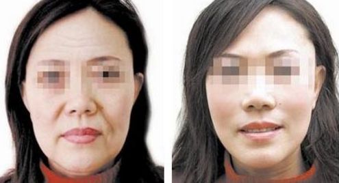 選娜楚玻尿酸還是伊婉？一篇幫你深度對(duì)比分析