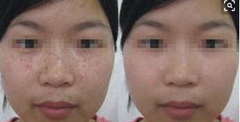 駐馬店中心醫(yī)院醫(yī)美科的專(zhuān)家醫(yī)生及眼綜合整形案例分析