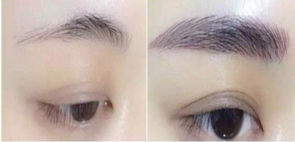 杭城薇琳醫(yī)療美容整形全套服務(wù)及雙眼皮成功案例