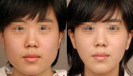 北京下巴自體脂肪墊術(shù)哪家醫(yī)院口碑好