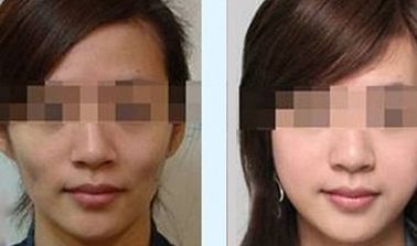 綿陽(yáng)哪家醫(yī)院做雙眼皮效果好