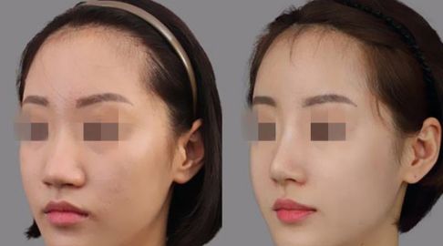 祛斑攻略：探秘激光去斑價格及術后護理要點