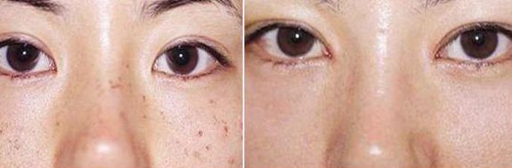 排名前五的廣醫(yī)二院雙眼皮醫(yī)生，價格參考2023