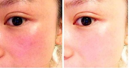 東莞鼻整形專家薈萃！治療頑固鼻部問題有招！