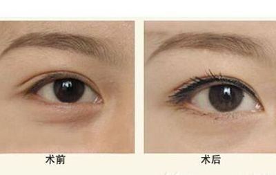 隆眉弓手術有哪些方法？如何成為隆眉保姆？