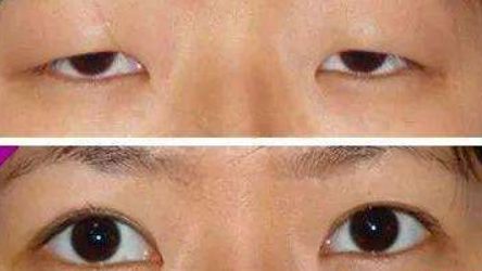 金華麗都整形為您呈現(xiàn)：雙眼皮神奇案例揭秘，專家力薦！