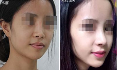 深圳哪家醫(yī)院隆胸效果好？排名前五火熱推薦！