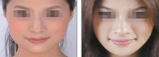 2024年適合自體豐胸的沈陽醫(yī)院有哪些好選擇？