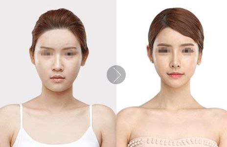 重慶華美面部拉皮價(jià)格：李富強(qiáng)V提小拉皮費(fèi)用及評價(jià)大揭秘