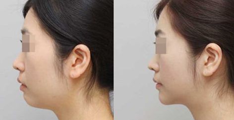 長春哪家醫(yī)院治療肋骨鼻效果好，推薦這些知名醫(yī)院