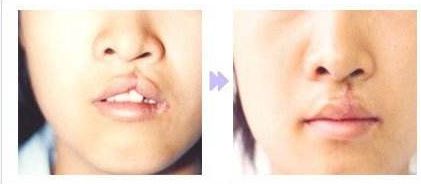 廣州假體隆胸整形優(yōu)質(zhì)機(jī)構(gòu)推薦